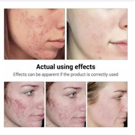 Breylee Acne Treatment Serum With Tea Tree Extract, Facial Essence To Anti Acne And Scar Removal For Clearing Acne, 4 image